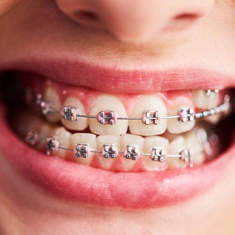 Lingual braces